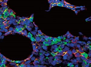 Descubren células ocultas que pueden provocar recaídas en la leucemia