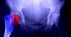 Expertos prevén que la osteoporosis se duplique en América Latina para 2050