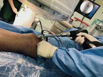 Médicos chilenos desarrollan novedosa técnica que evita infecciones en paciente con fracturas