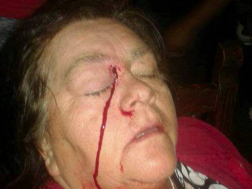 Mujer de 58 años en peligro de perder un ojo por perdigón de Carabineros en medio de protesta por el agua en Villarrica