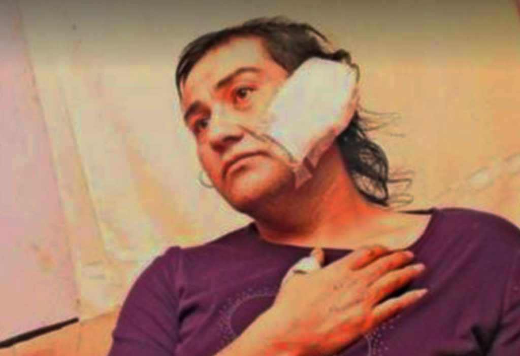 Denuncian grave ataque con machete a mujer trans en San Carlos: Fue herida en el rostro, cabeza y oreja
